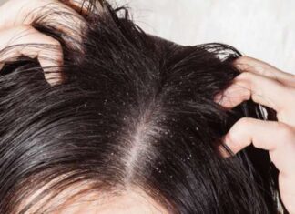 Ilustrasi ketombe, rambut berketombe (shutterstock)